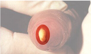 男性淋病都有那些症状？如何治疗？