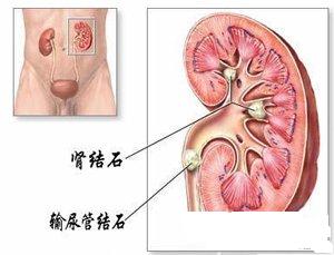 输尿管结石手术费用